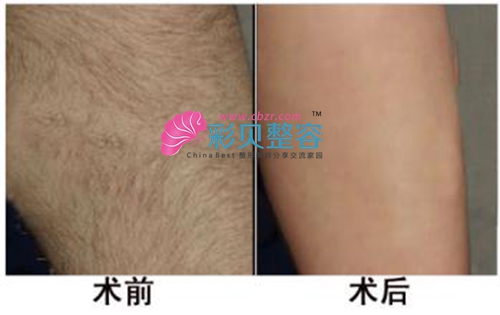 激光脱毛效果