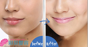 酒窝再造对比图