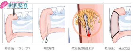 手臂吸脂原理