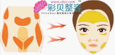 自体脂肪填充