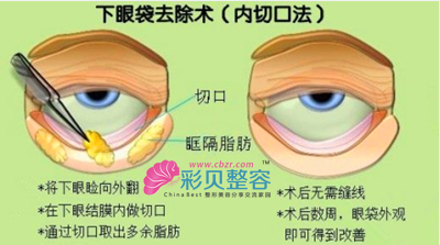 下眼袋去除手术漫画示意图