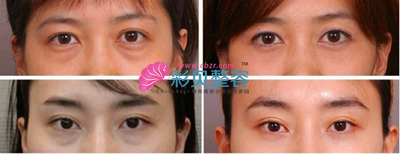 年纪轻轻就有眼袋 可以这样抛弃它