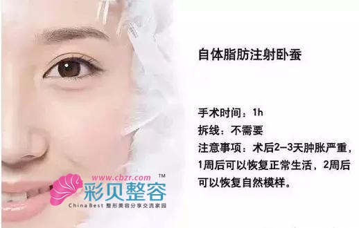 自体脂肪丰卧蚕
