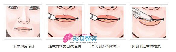玻尿酸丰唇原理图
