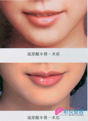 玻尿酸丰唇前后对比图
