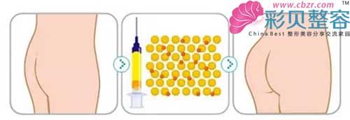 自体脂肪丰臀