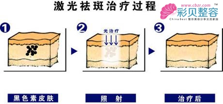 激光祛斑治疗过程