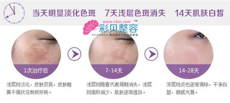 激光祛斑治疗见效时间