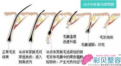 冰点脱毛原理