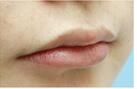 自体脂肪丰唇效果很满意