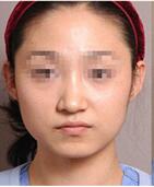 做完面部吸脂脸小了一圈