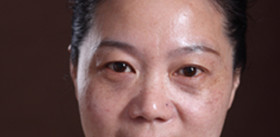 丽都整形医院面部年轻化手术案例