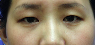 丽都整形医院双眼皮手术案例