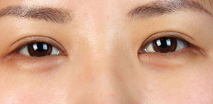 丽都整形医院双眼皮手术案例