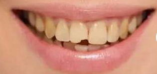 丽都整形医院牙齿矫正手术案例