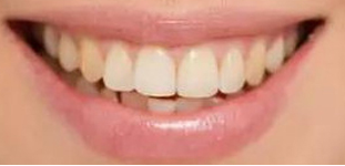 丽都整形医院牙齿矫正手术案例