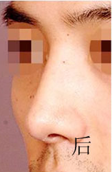 驼峰鼻矫正手术案例