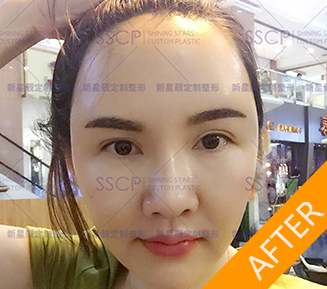 北京新星靓面部年轻化手术案例
