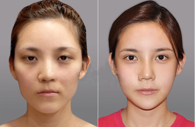 深圳南西子医疗美容门诊部 双眼皮修复案例