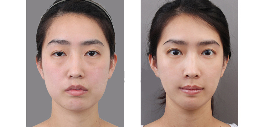 深圳南西子医疗美容门诊部开眼角眼部上提案例