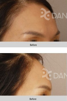 自体脂肪丰额头手术案例