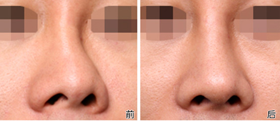 自体软骨隆鼻.jpg