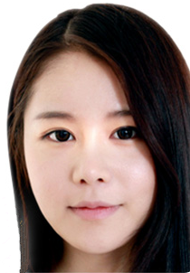 韩式无痕双眼皮案例