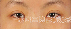 重睑修复案例