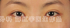 重睑修复案例