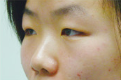隆鼻术案例