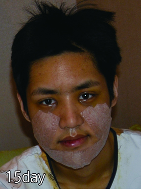 咨询院长后做了眼睛 颧骨和下巴整形