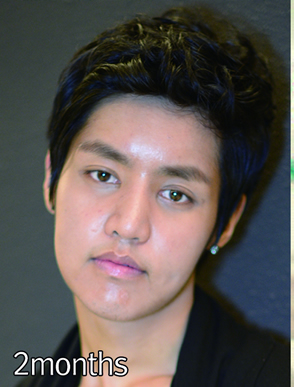 两个月还有有一点点肿~