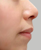隆鼻+鼻尖整形案例