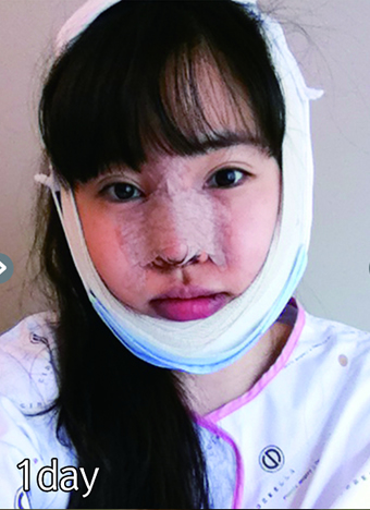 医生设计方案：电眼 隆鼻 V脸轮廓