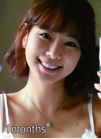 1个月已经恢复的很不错了