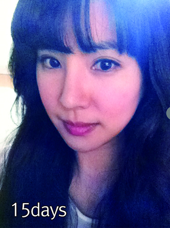 很庆幸选择了新帝瑞娜，消肿很快~