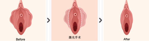 小阴唇整形案例.jpg