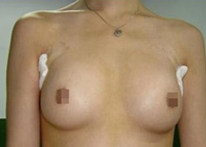隆乳术案例