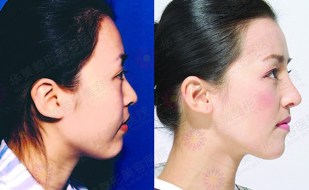正版达拉斯美鼻手术前后对比图.jpg