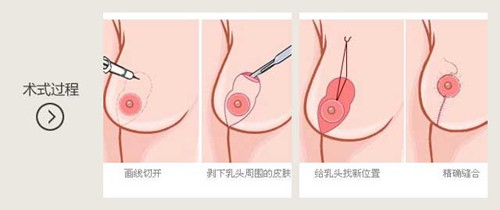 乳房上提手术过程