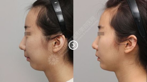 下巴整形案例.jpg