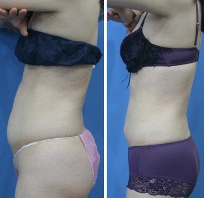腰腹吸脂手术案例.jpg
