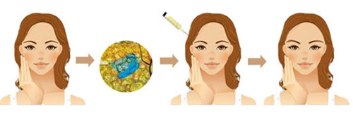 自体脂肪丰太阳穴