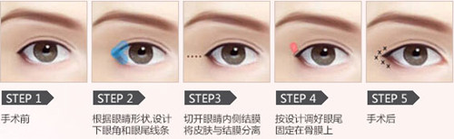 韩式无痕开眼角