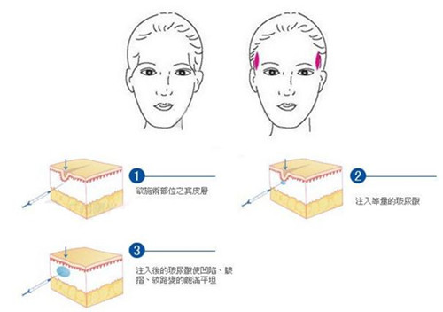 玻尿酸丰太阳穴