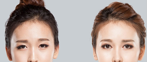 太原华美整形双眼皮案例效果图