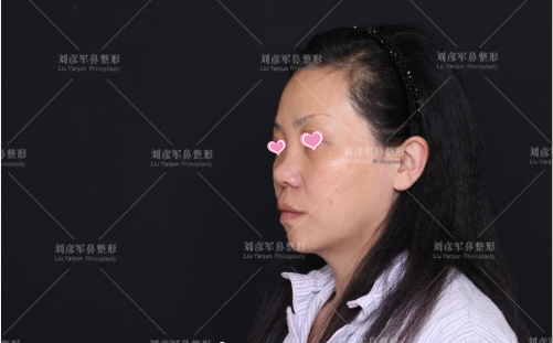 在北京沃尔整形做隆鼻修复前45读样子