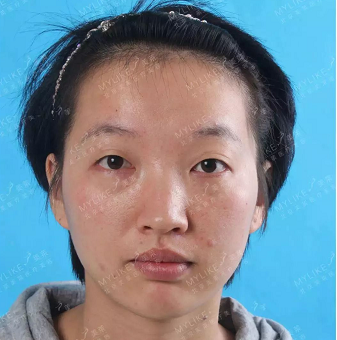 北京美莱整形医院叶宇双眼皮术前