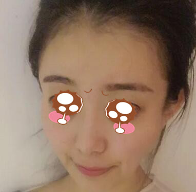 在广州壹加壹做面部脂肪填充前