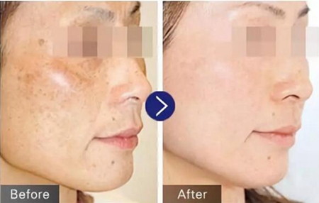 徐州心源激光去黄褐斑案例